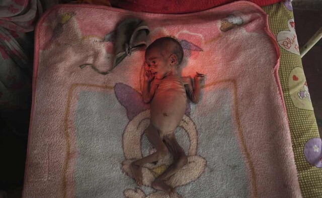 Four-month-old Vishakha, who weighs 2.3 kg (5 lbs) and suffers from severe malnutrition, has her picture taken as she lies on a bed at the Nutritional Rehabilitation Centre of Shivpuri in Madhya Pradesh. Reuters Four-month-old Vishakha, who weighs 2.3 kg (5 lbs) and suffers from severe malnutrition, has her picture taken as she lies on a bed at the Nutritional Rehabilitation Centre of Shivpuri in Madhya Pradesh. Reuters