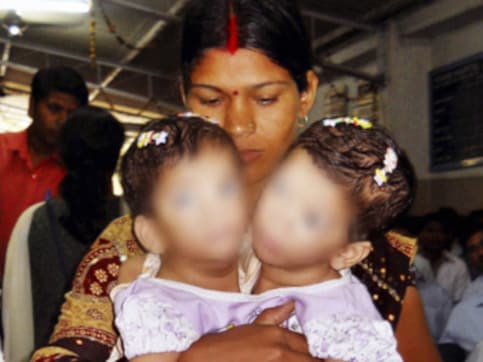 Conjoined twins separated after 12-hour surgery in MP Conjoined twins separated after 12-hour surgery in MP