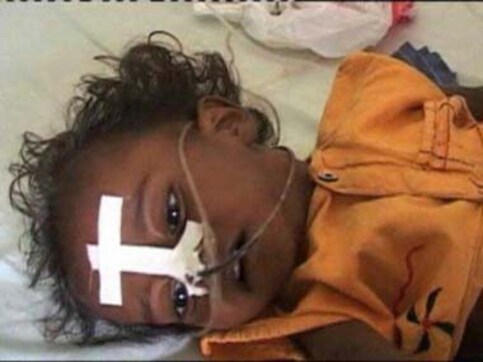 Five more children die of encephalitis, toll rises to 445 Five more children die of encephalitis, toll rises to 445