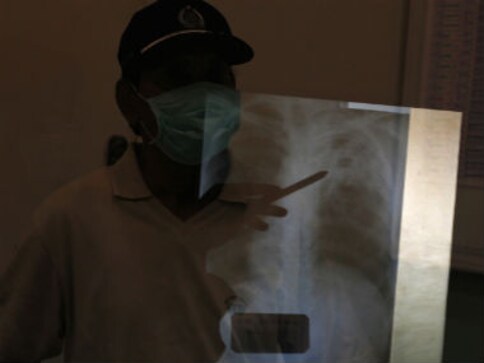 Equip private clinics better to fight Tuberculosis in India: study Equip private clinics better to fight Tuberculosis in India: study