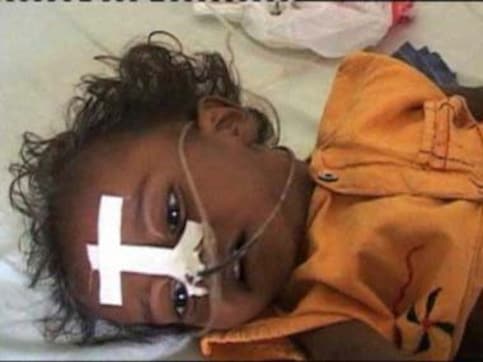 Arunachal sounds high alert after girl dies of encephalitis Arunachal sounds high alert after girl dies of encephalitis