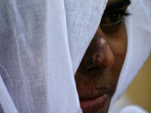 186 of 310 acid attack cases in Uttar Pradesh in 2014: Govt tells Lok Sabha 186 of 310 acid attack cases in Uttar Pradesh in 2014: Govt tells Lok Sabha