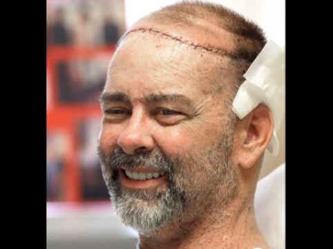 First ever skull-scalp transplant surgery performed by US doctors First ever skull-scalp transplant surgery performed by US doctors