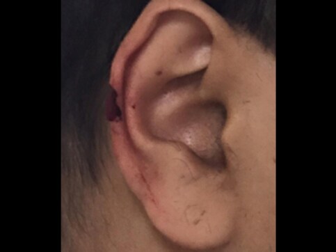 Hairstylist in Mumbai salon accidentally chops off part of man's ear Hairstylist in Mumbai salon accidentally chops off part of man's ear