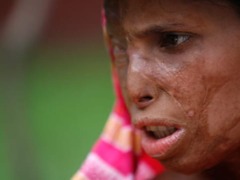 Reviving hope: Project to offer free plastic surgeries for acid attack victims Reviving hope: Project to offer free plastic surgeries for acid attack victims