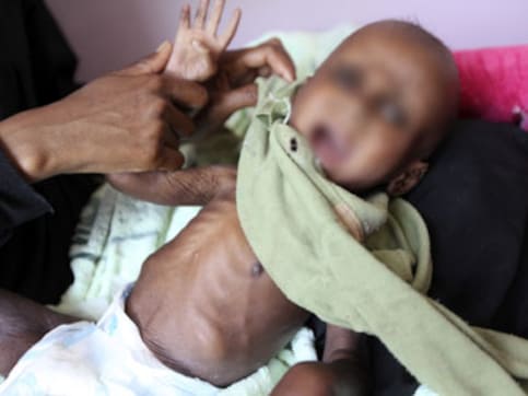 Study links underweight children in urban India with social backwardness, illiteracy and lack of toilets Study links underweight children in urban India with social backwardness, illiteracy and lack of toilets