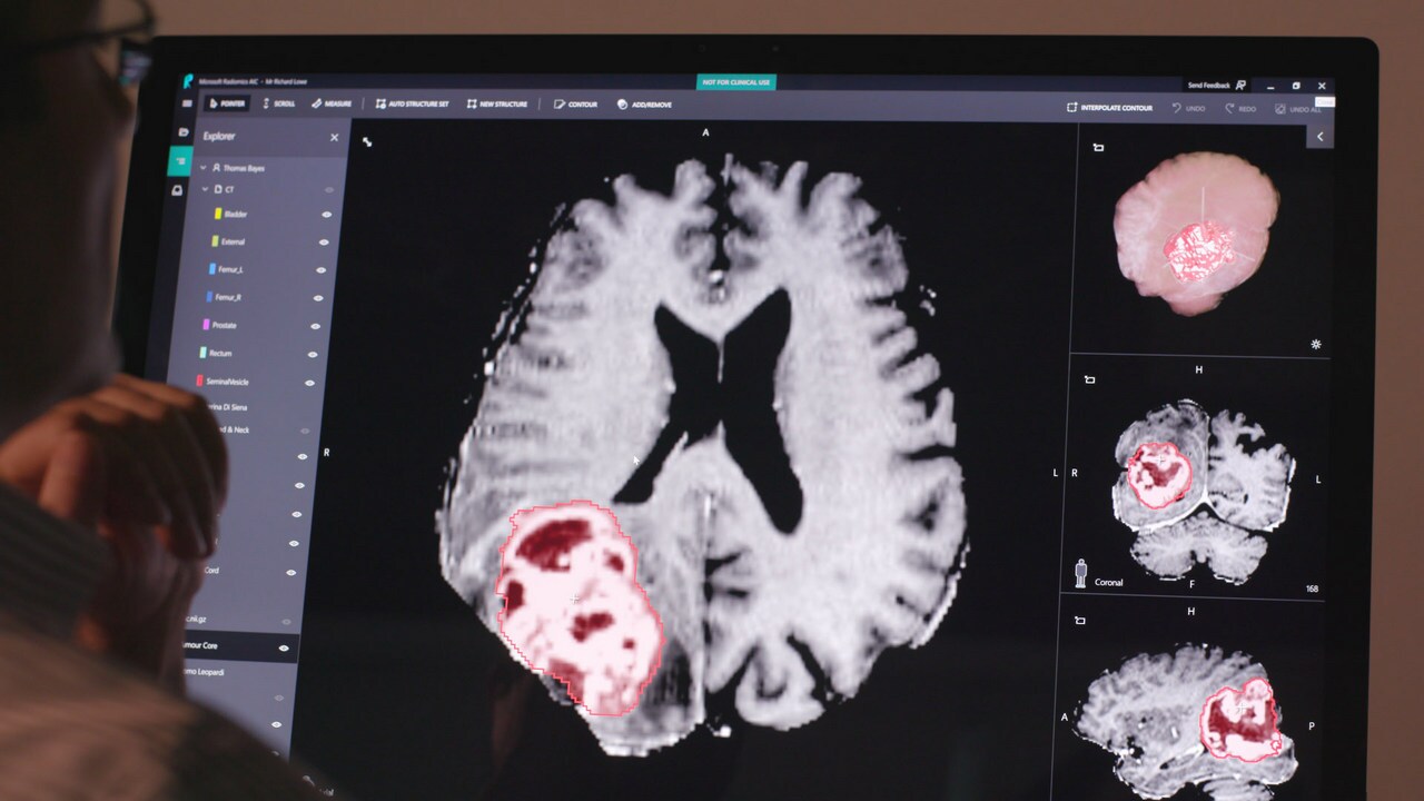 Project InnerEye develops machine learning techniques for the automatic delineation of tumors as well as healthy anatomy in 3D radiological images. Image: St. Jude Children’s Research Hospital.