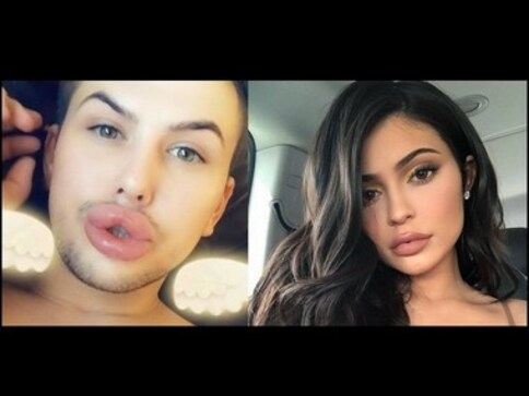 Kylie Jenner's fan tries imitating her pout, excessive fillers spill out of lips Kylie Jenner's fan tries imitating her pout, excessive fillers spill out of lips