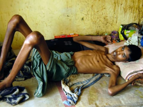 Battle against drug-resistant TB: Like South Africa, India needs to allow access to 'game-changing' bedaquiline, says researcher Battle against drug-resistant TB: Like South Africa, India needs to allow access to 'game-changing' bedaquiline, says researcher