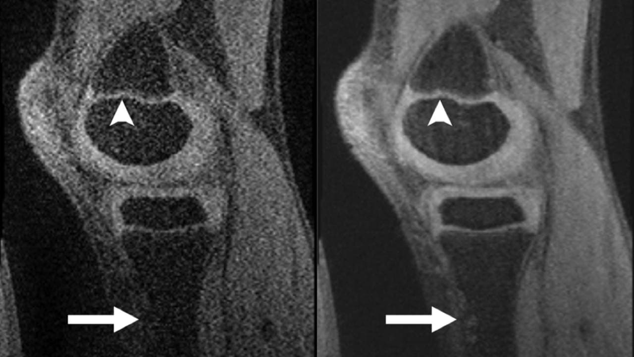 A CS MRI scan of the knee (on the right) shows more detail and resolution than a regular MRI on the left. Image courtesy: Radiology/Vasanawala et al