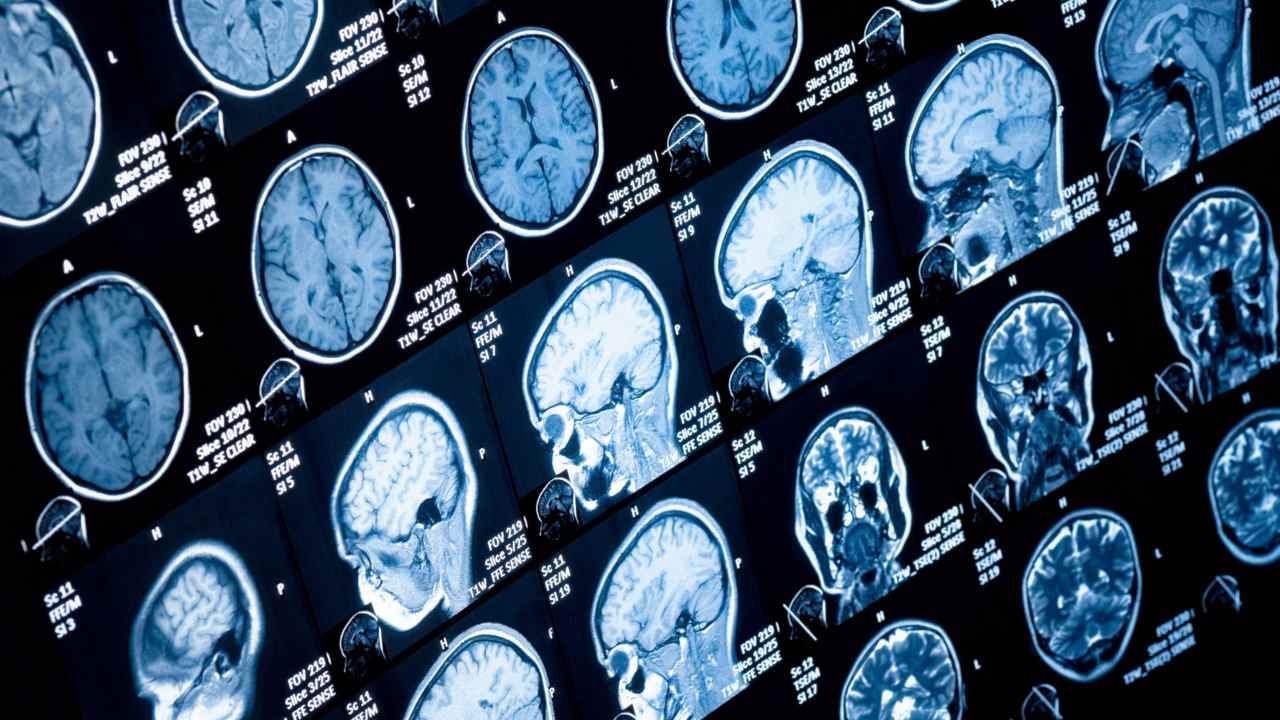 A collection of brain CT scans to spot tumours. Image courtesy: NCL UK