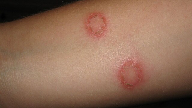 Drug resistance not the only reason for failure to treat ringworm say dermatologists Drug resistance not the only reason for failure to treat ringworm say dermatologists