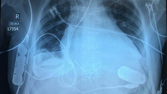 World's first bionic heart charges wirelessly inside 24 year old patient's chest World's first bionic heart charges wirelessly inside 24 year old patient's chest