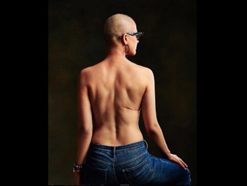Tahira Kashyap shares post-surgery photo on World Cancer Day: 'I truly embrace my scars'