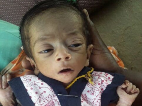 Congress in Madhya Pradesh adopts erstwhile BJP govt's inaction, fails to tackle malnutrition plaguing several districts Congress in Madhya Pradesh adopts erstwhile BJP govt's inaction, fails to tackle malnutrition plaguing several districts