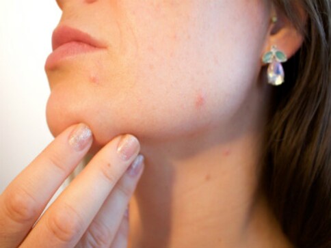 Four easy-peasy home remedies for acne Four easy-peasy home remedies for acne
