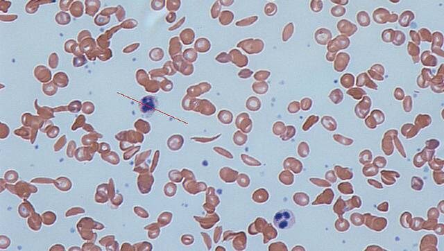World Sickle Cell Awareness Day 2020: All you need to know about the haemoglobin disorder affecting normal blood flow, its symptoms and treatment World Sickle Cell Awareness Day 2020: All you need to know about the haemoglobin disorder affecting normal blood flow, its symptoms and treatment