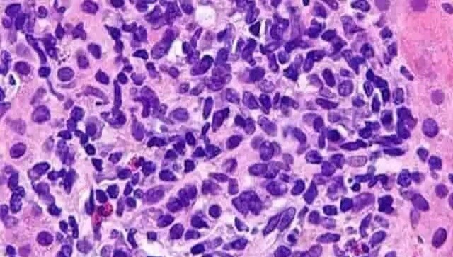 MG53, a natural protein, can help stop life-threatening lung inflammation associated with flu, suggests study MG53, a natural protein, can help stop life-threatening lung inflammation associated with flu, suggests study