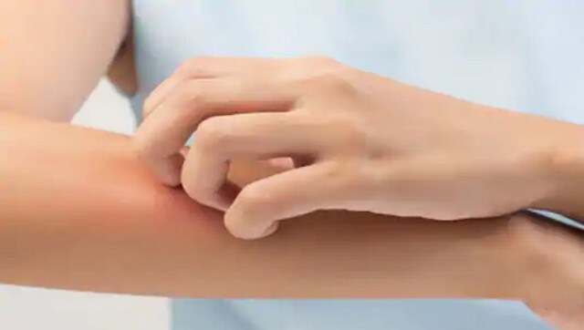 Why does the immune system respond to allergens by triggering itching in the skin? Why does the immune system respond to allergens by triggering itching in the skin?
