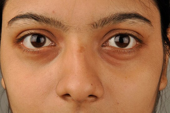 Treating dark circles, healing wounds and more: Some benefits of coconut oil Treating dark circles, healing wounds and more: Some benefits of coconut oil