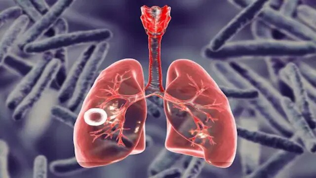 21.4 lakh new TB cases reported in India in 2021, 18% higher than previous year: WHO report