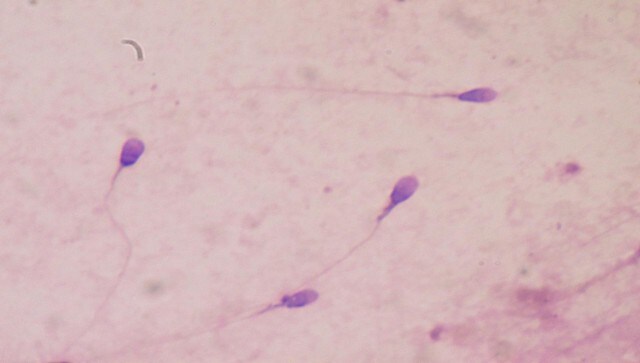A bleak future for mankind: Why is there a significant decline in sperm count globally including India?