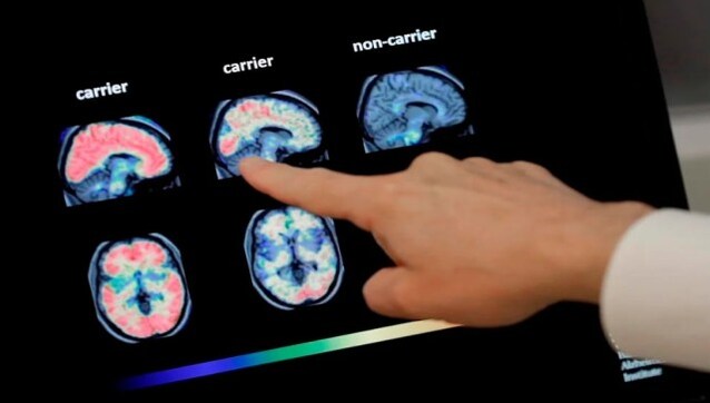 How a 19-year-old teenager was diagnosed with Alzheimer’s disease How a 19-year-old teenager was diagnosed with Alzheimer’s disease