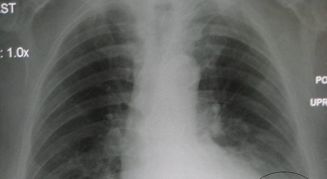 IIT professor developed a software that detects Coronavirus in five seconds by using the patient's X-ray scan IIT professor developed a software that detects Coronavirus in five seconds by using the patient's X-ray scan