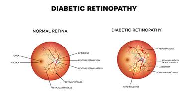 Managing Diabetic Retinopathy In India - A Not So Sweet Pill