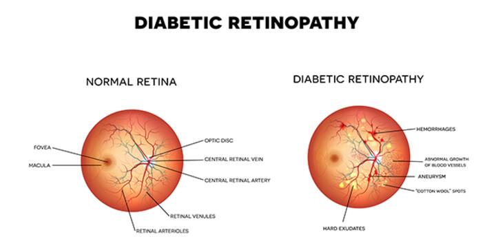 Managing Diabetic Retinopathy In India - A Not So Sweet Pill