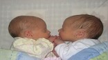 Brazilian woman gives birth to twins with different biological fathers, here's how