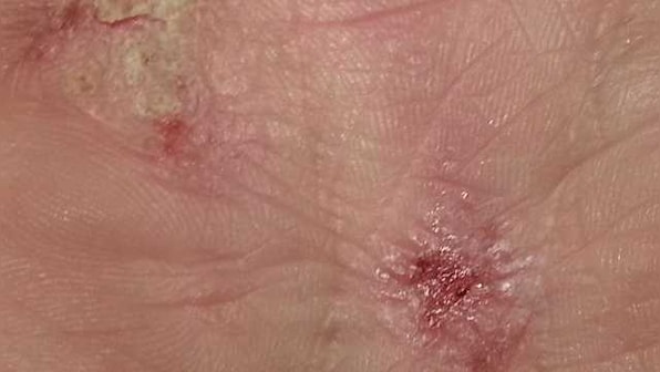 Severe and persistent Atopic Dermatitis and flare-ups: All you need to know