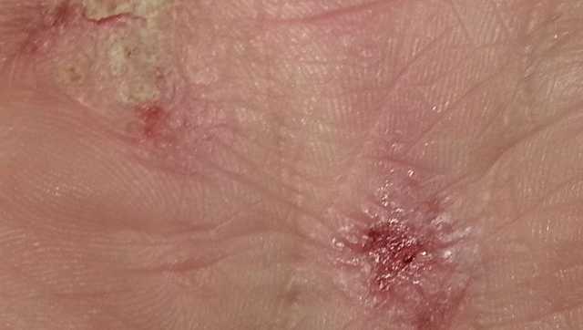 Severe and persistent Atopic Dermatitis and flare-ups: All you need to know Severe and persistent Atopic Dermatitis and flare-ups: All you need to know