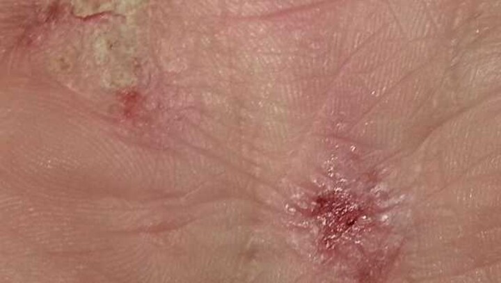 Severe and persistent Atopic Dermatitis and flare-ups: All you need to know