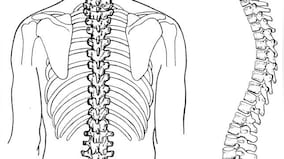 Spinal Muscular Atrophy: Causes and importance of early diagnosis for proactive management