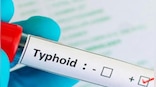Typhoid treatment: Five home remedies to deal with it