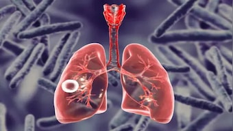 21.4 lakh new TB cases reported in India in 2021, 18% higher than previous year: WHO report