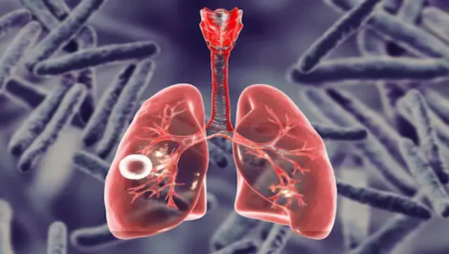 21.4 lakh new TB cases reported in India in 2021, 18% higher than previous year: WHO report 21.4 lakh new TB cases reported in India in 2021, 18% higher than previous year: WHO report