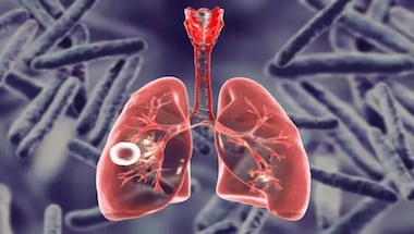 21.4 lakh new TB cases reported in India in 2021, 18% higher than previous year: WHO report