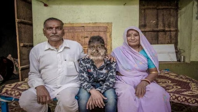 Madhya Pradesh teen suffers from ‘werewolf syndrome’: What is it? Is there a cure? Madhya Pradesh teen suffers from ‘werewolf syndrome’: What is it? Is there a cure?