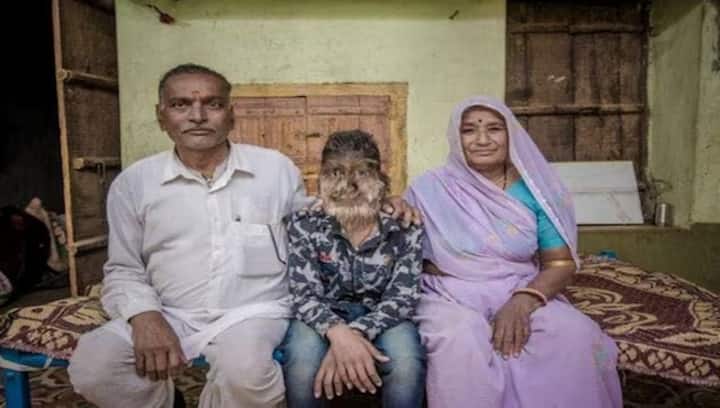 Madhya Pradesh teen suffers from ‘werewolf syndrome’: What is it? Is there a cure?