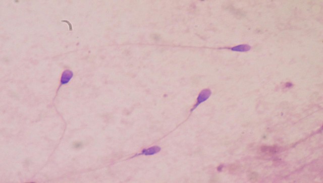 A bleak future for mankind: Why is there a significant decline in sperm count globally including India? A bleak future for mankind: Why is there a significant decline in sperm count globally including India?