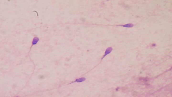 A bleak future for mankind: Why is there a significant decline in sperm count globally including India?