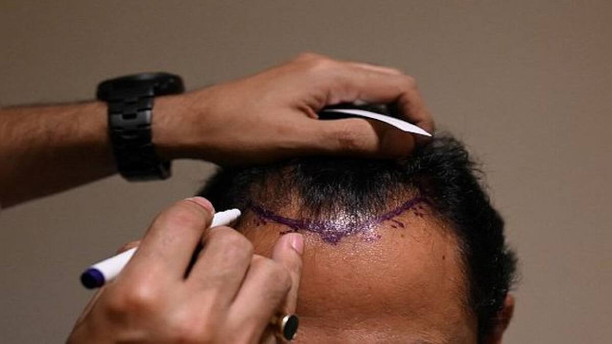 Hair Scare How fear of going bald is leading to deaths in India Firstpost