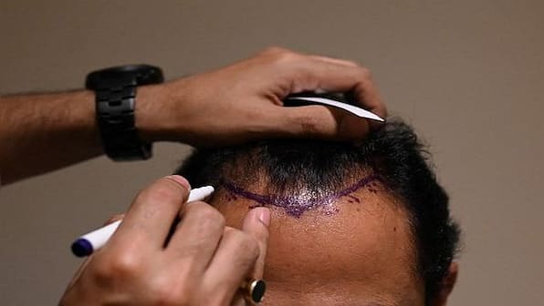 Hair Scare: How fear of going bald is leading to deaths in India