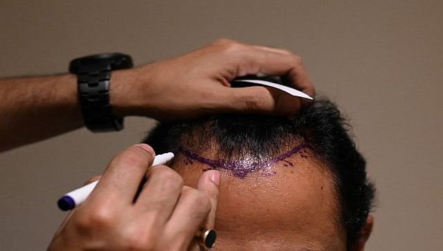 Hair Scare: How fear of going bald is leading to deaths in India Hair Scare: How fear of going bald is leading to deaths in India