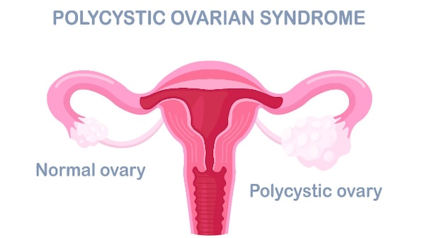 Lean PCOS may remain undiagnosed due to normal BMI levels