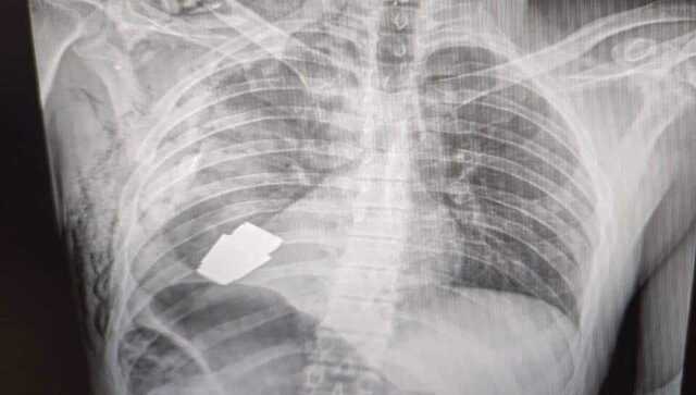 Live grenade removed from Ukrainian soldier's chest, from just below his heart Live grenade removed from Ukrainian soldier's chest, from just below his heart