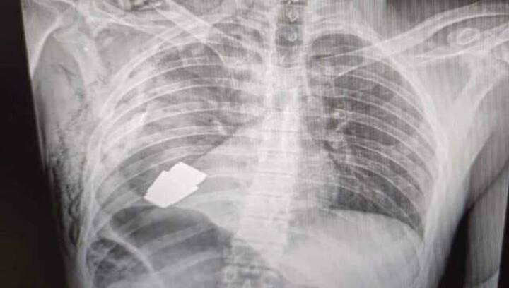 Live grenade removed from Ukrainian soldier's chest, from just below his heart