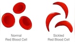 What is sickle cell anaemia, which India plans to eliminate by 2047?